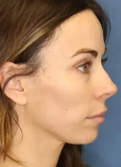 A result from South Coast Plastic Surgery Ladera Ranch