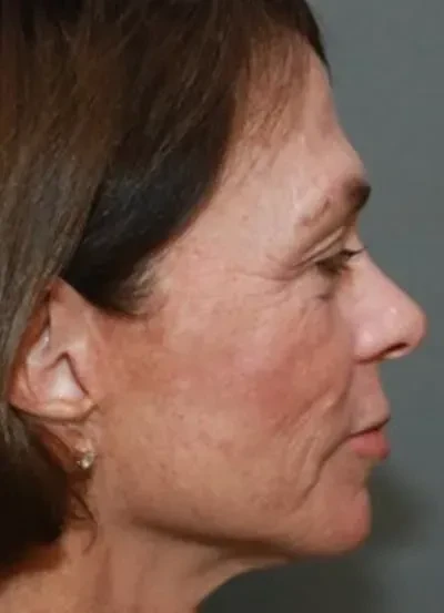 A result from South Coast Plastic Surgery Ladera Ranch