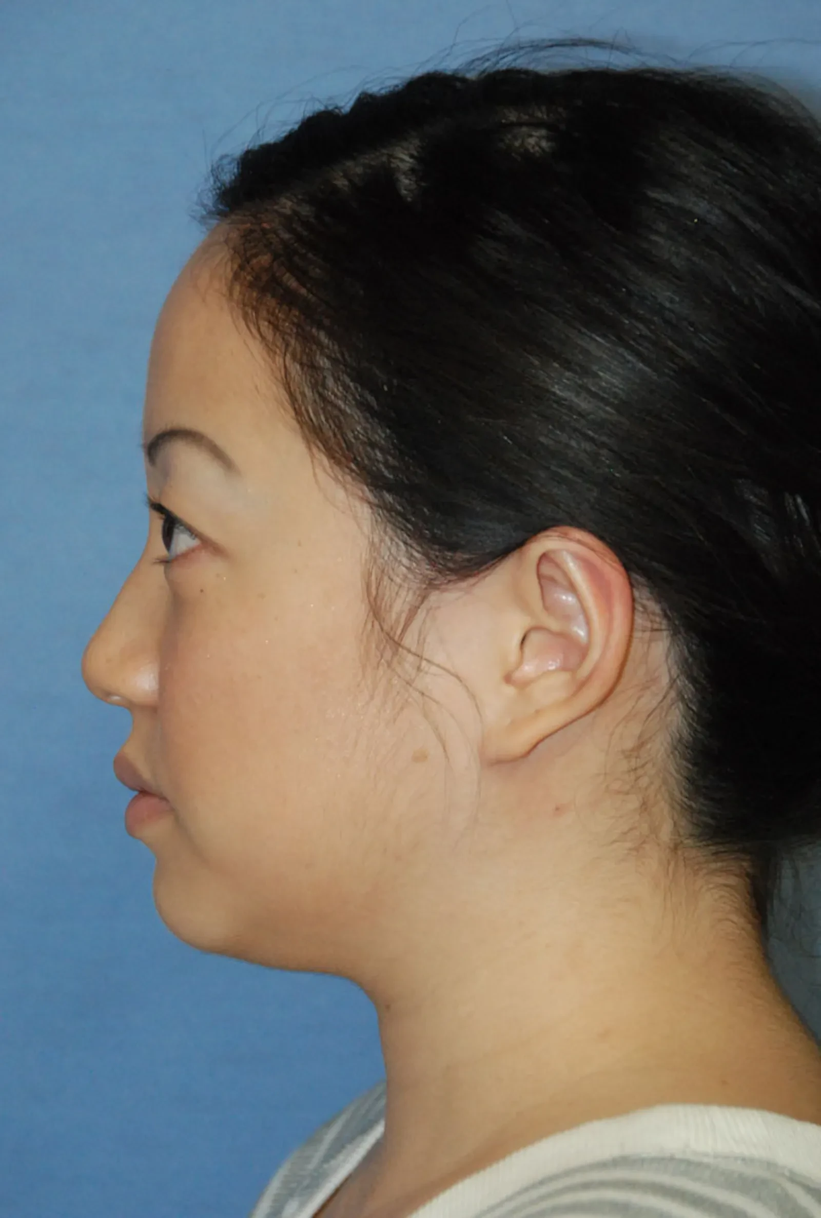 A result from Aesthetic Facial Plastic Surgery – Dr. Philip Young MD