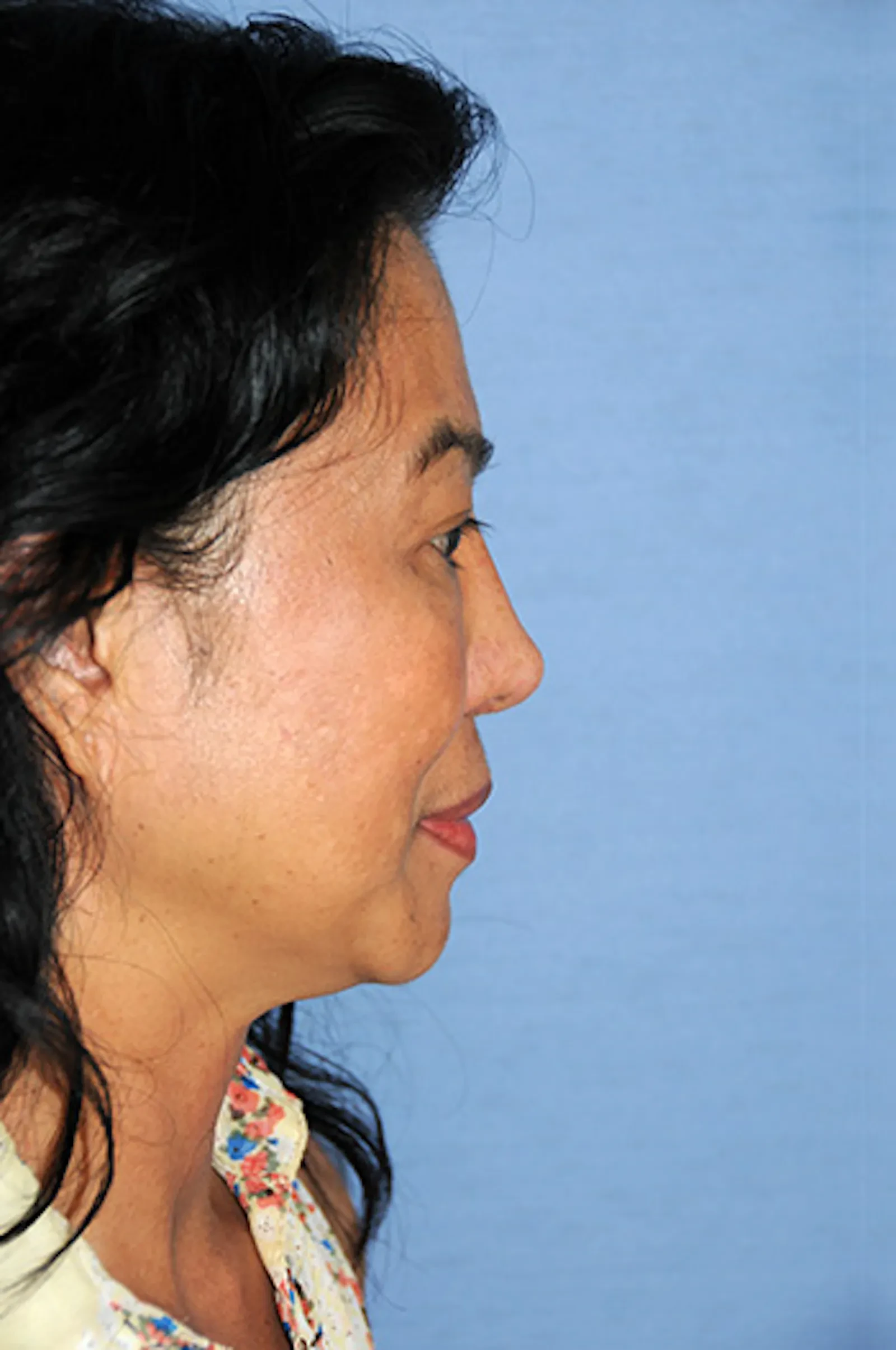 A result from Aesthetic Facial Plastic Surgery – Dr. Philip Young MD