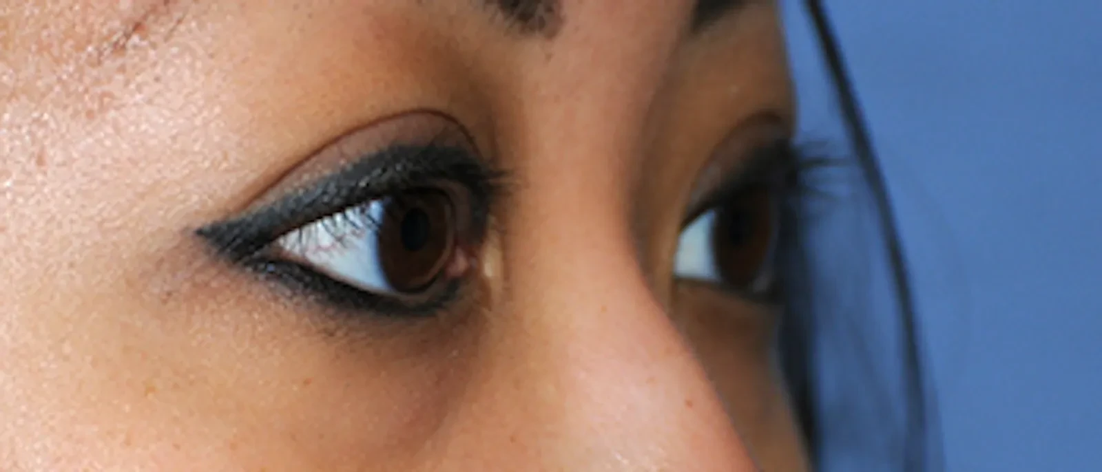 A result from Aesthetic Facial Plastic Surgery – Dr. Philip Young MD
