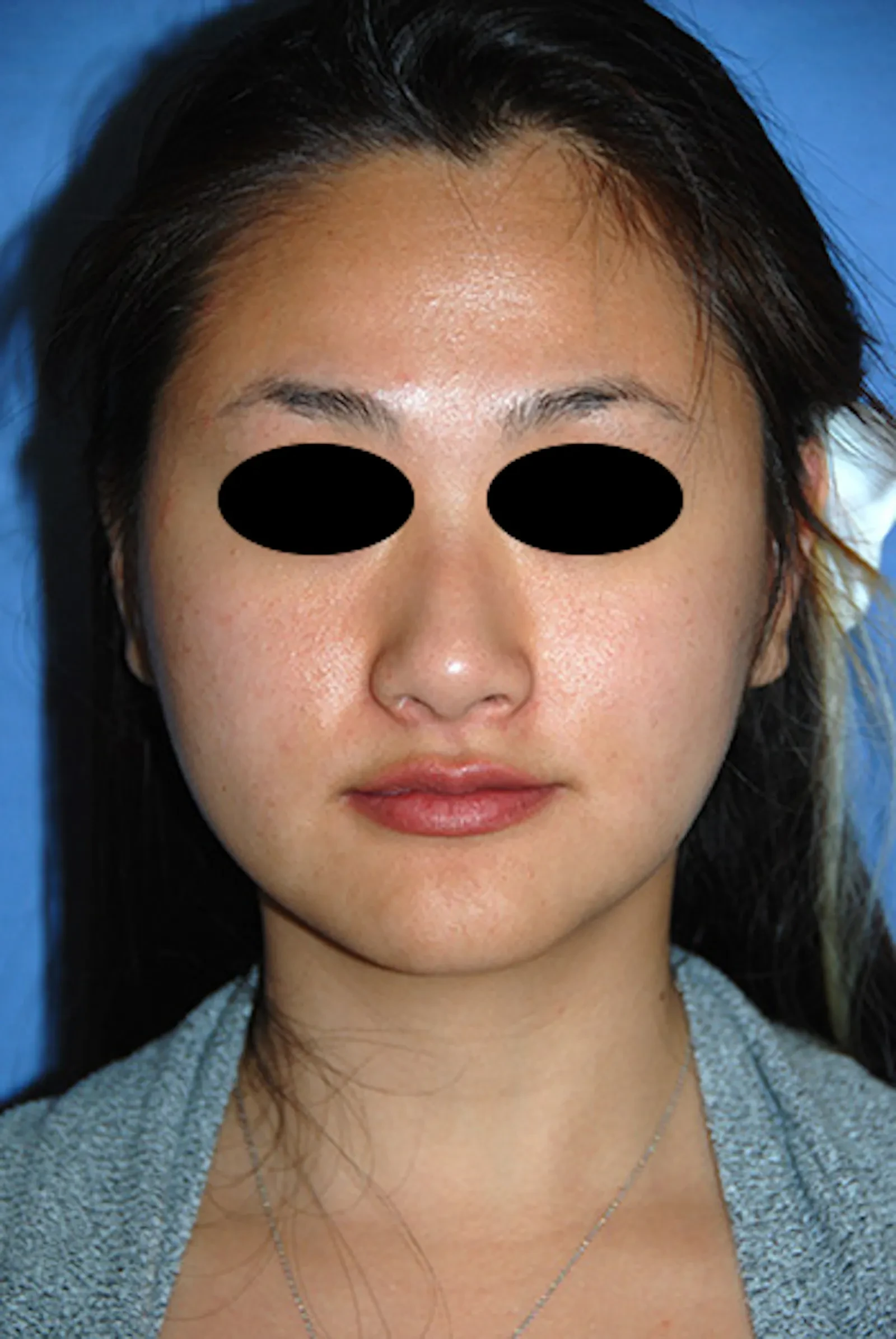 A result from Aesthetic Facial Plastic Surgery – Dr. Philip Young MD