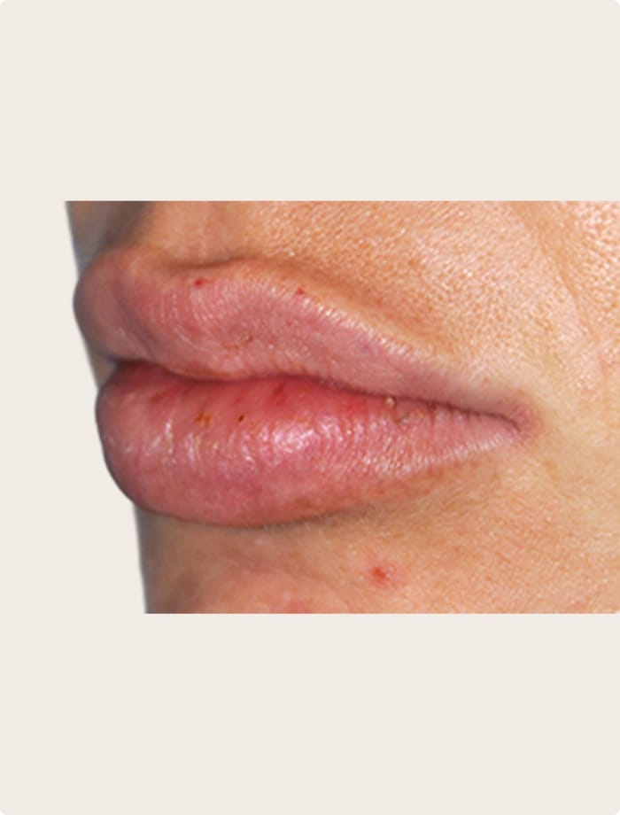 A result from Aesthetic Facial Plastic Surgery – Dr. Philip Young MD