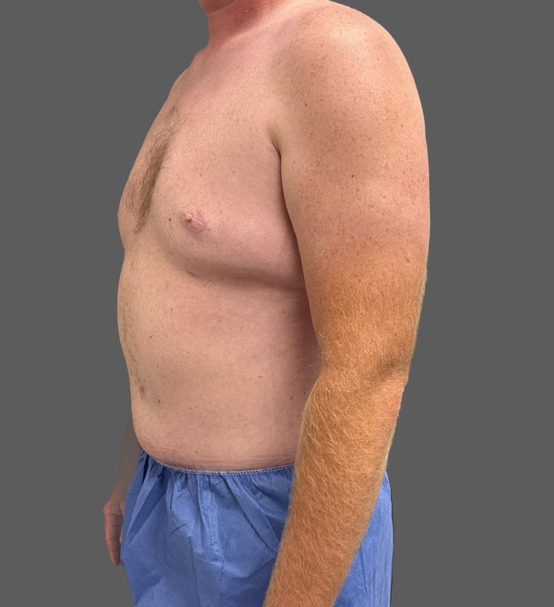 A result from Alpine Plastic Surgery