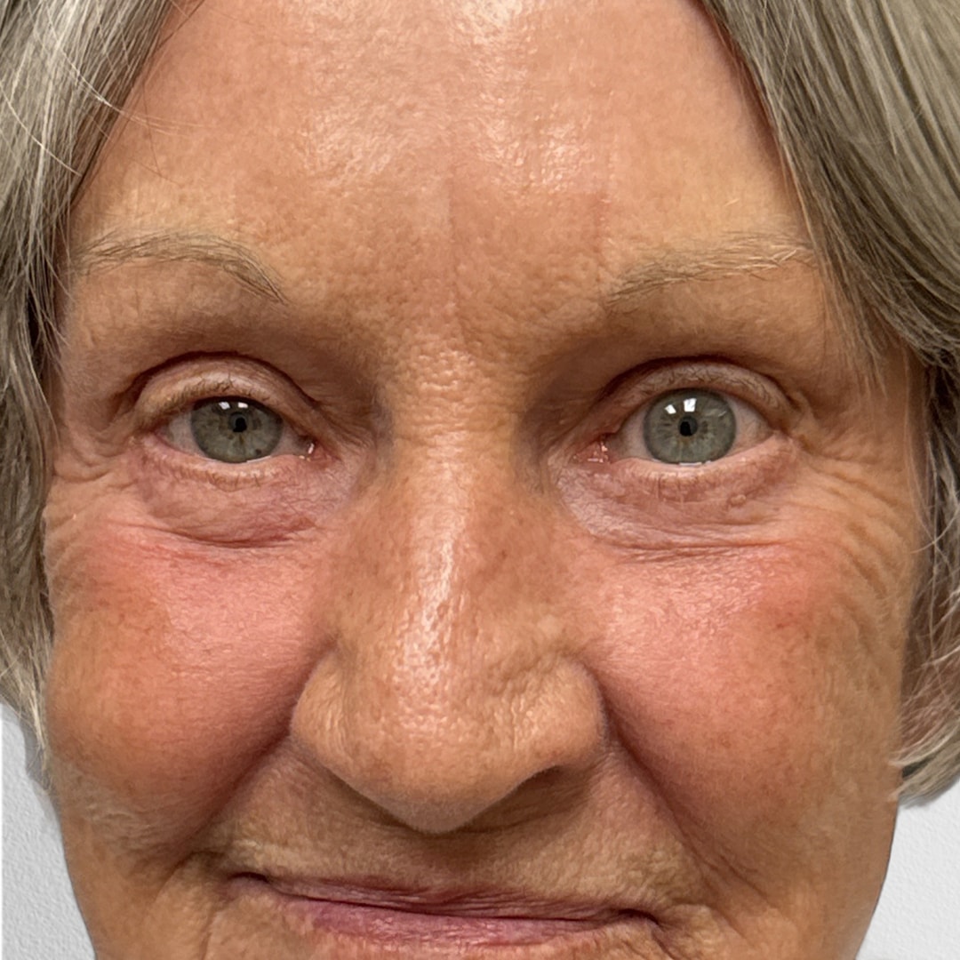 A result from Alpine Plastic Surgery