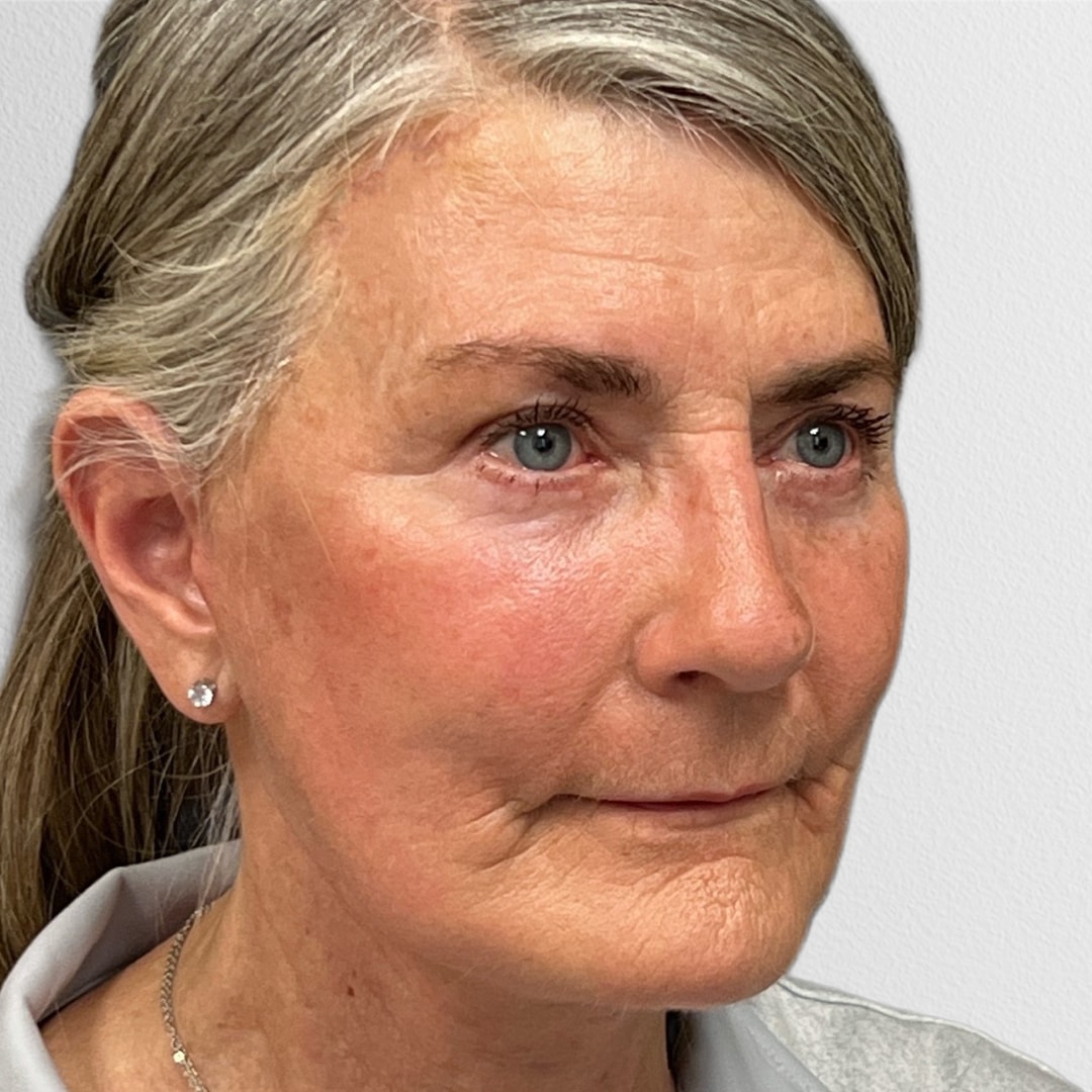 A result from Alpine Plastic Surgery