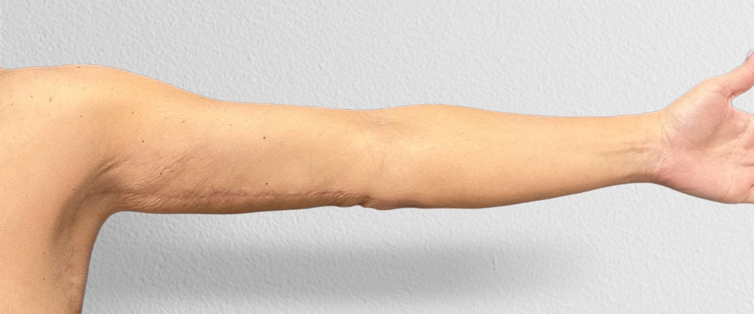 A result from Alpine Plastic Surgery