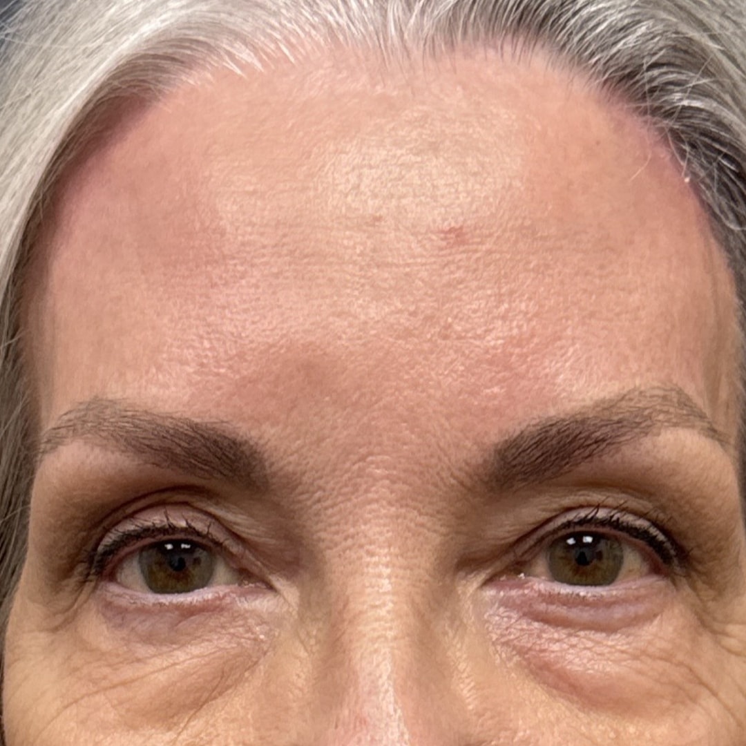 A result from Alpine Plastic Surgery