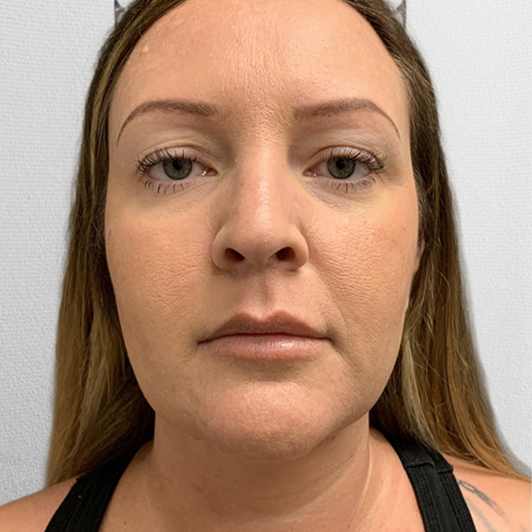 A result from Alpine Plastic Surgery