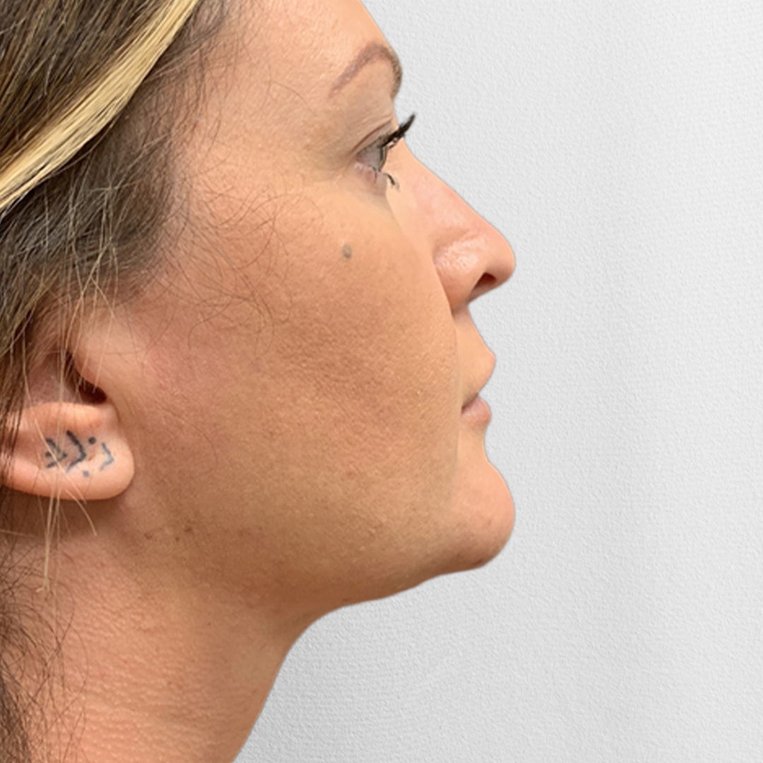 A result from Alpine Plastic Surgery