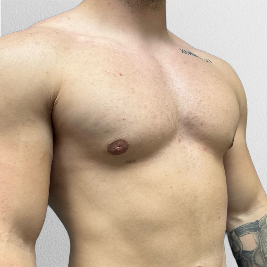 A result from Alpine Plastic Surgery