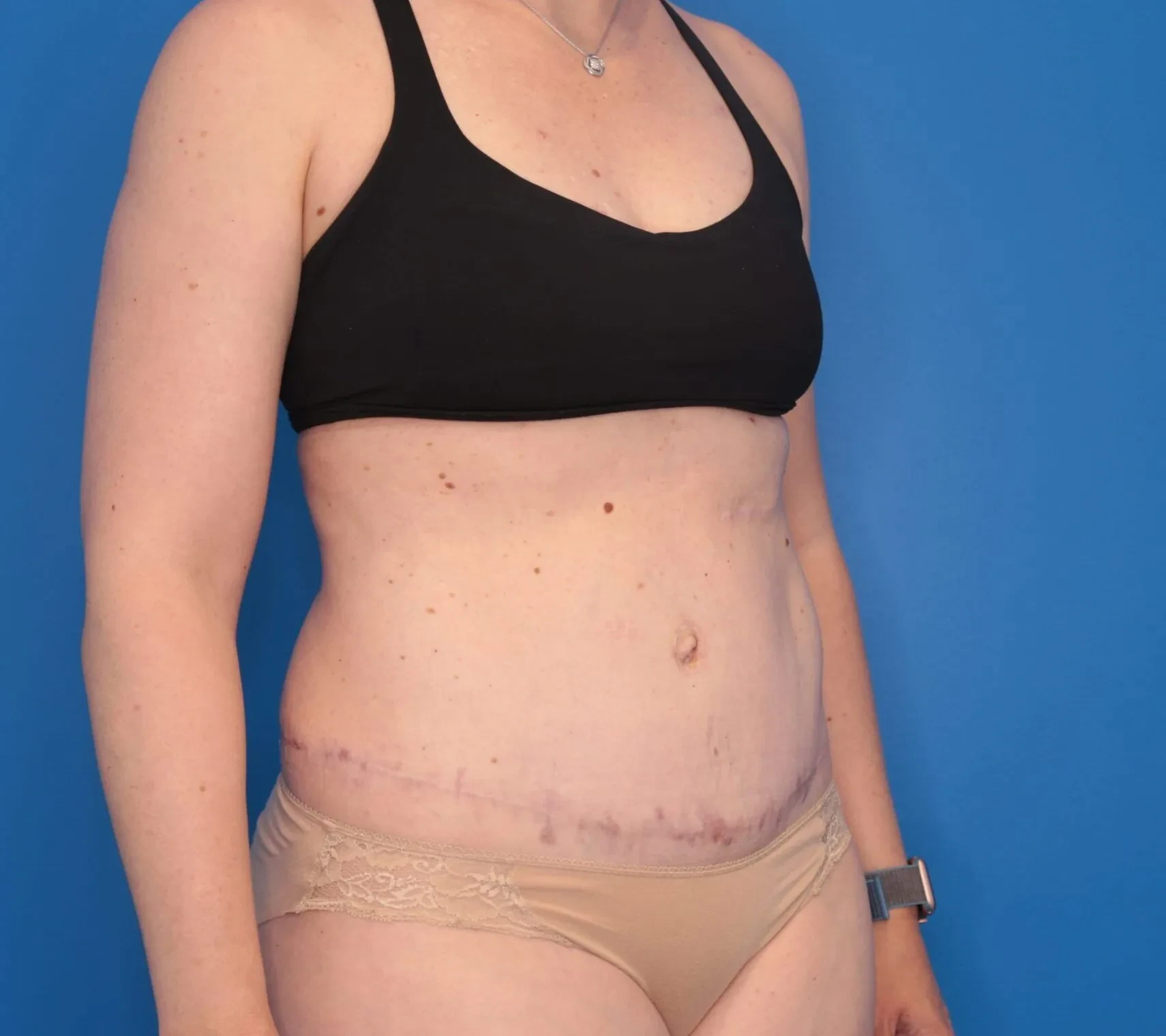 A result from Montante Plastic Surgery & Aesthetics