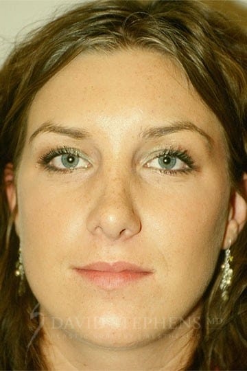 A result from Stephens Plastic Surgery