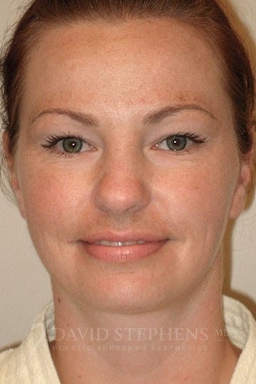 A result from Stephens Plastic Surgery