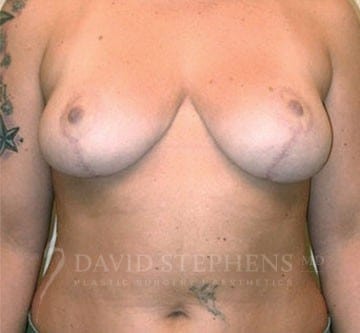 A result from Stephens Plastic Surgery