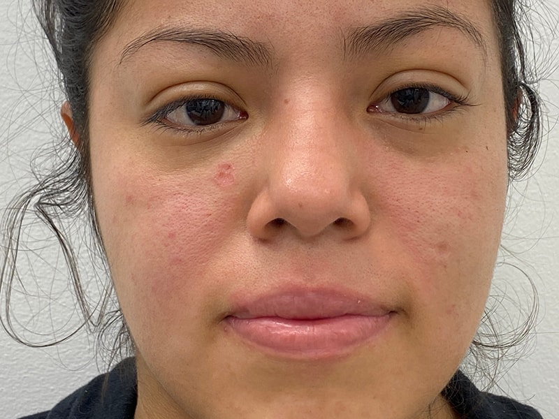 A result from Skinzone Laser & Cosmetic Surgery: Dr. Hannah Vu, MD