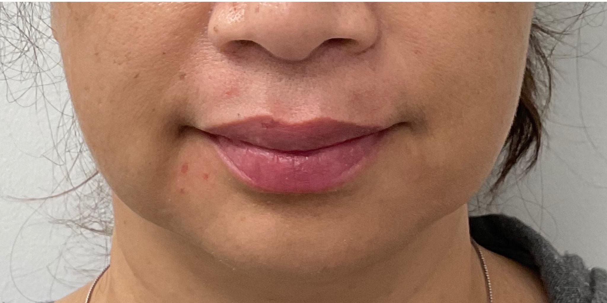 A result from Skinzone Laser & Cosmetic Surgery: Dr. Hannah Vu, MD
