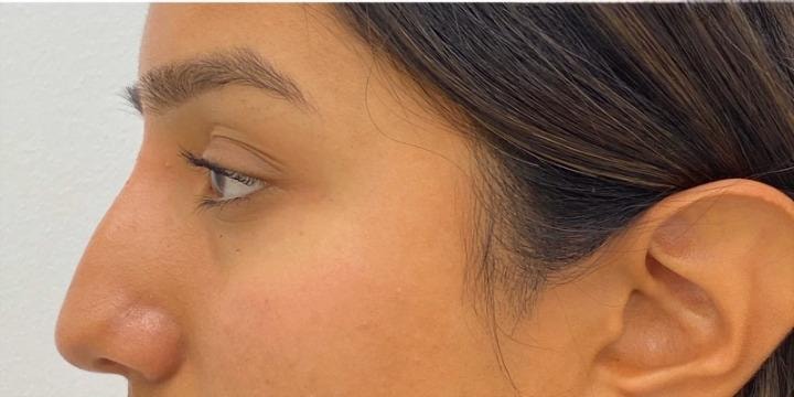 A result from Skinzone Laser & Cosmetic Surgery: Dr. Hannah Vu, MD