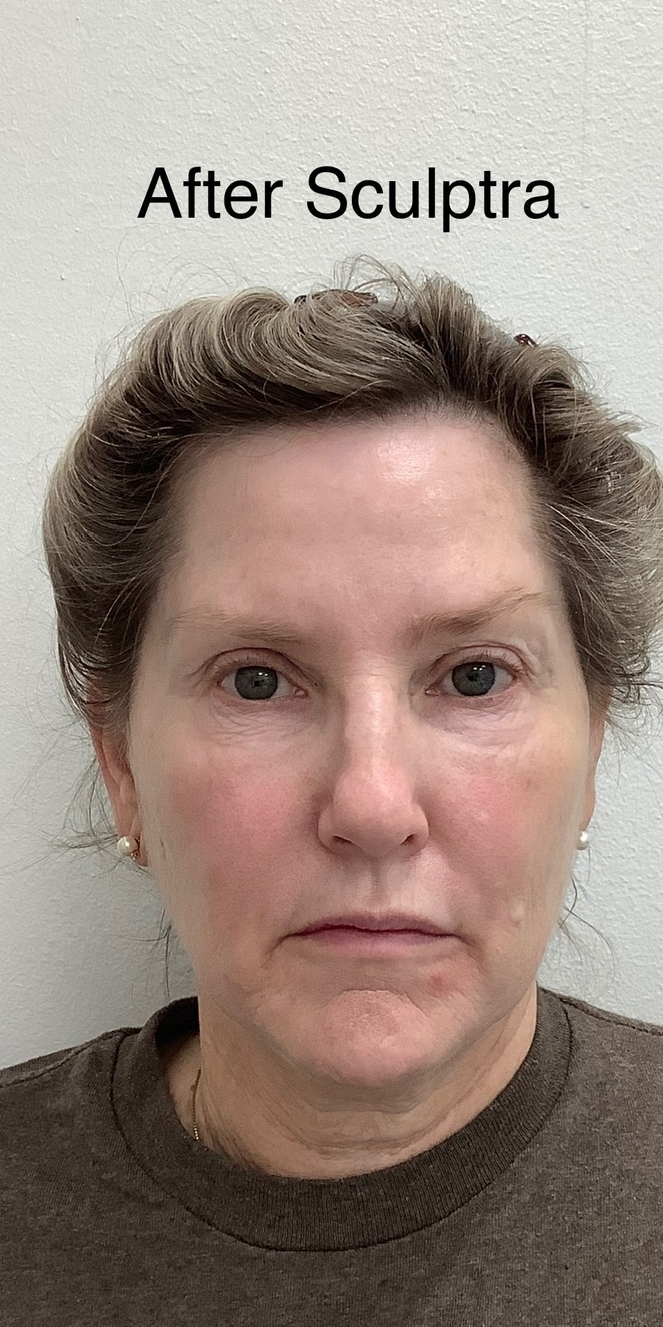 A result from Skinzone Laser & Cosmetic Surgery: Dr. Hannah Vu, MD