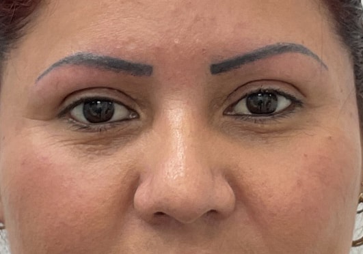 A result from Skinzone Laser & Cosmetic Surgery: Dr. Hannah Vu, MD