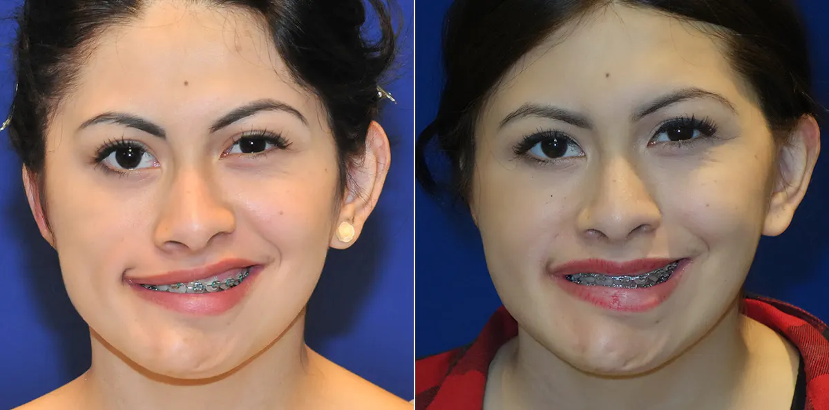 Andre Panossian, MD, Plastic Surgery veneers after — Pasadena, CA