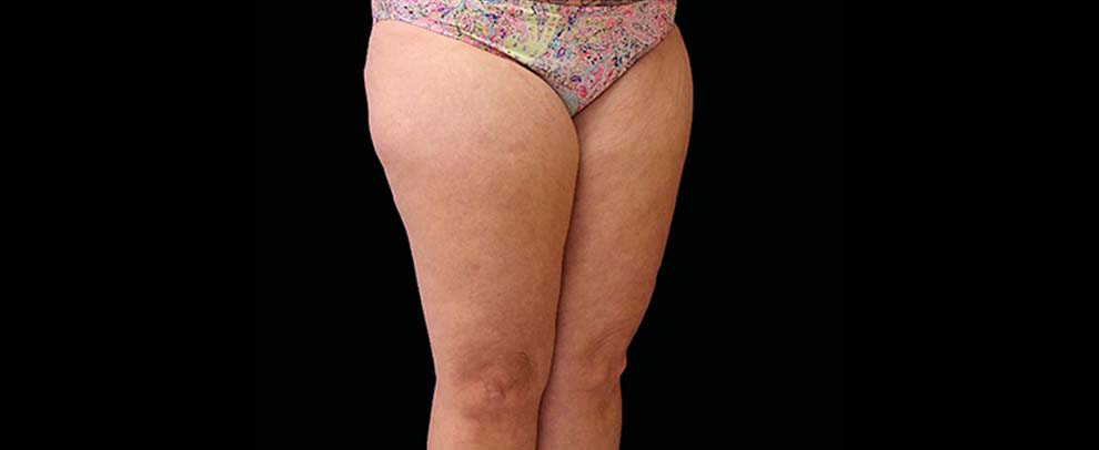 A result from Vitalyc Medspa | Highland Park