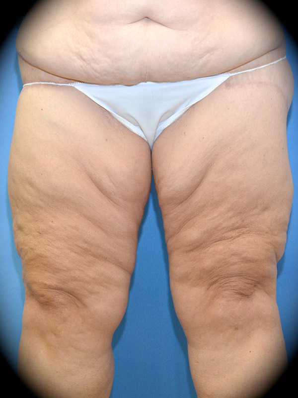 A result from Pasadena Cosmetic Surgery