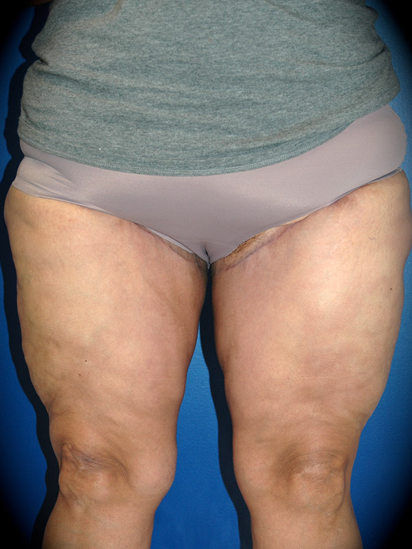 A result from Pasadena Cosmetic Surgery