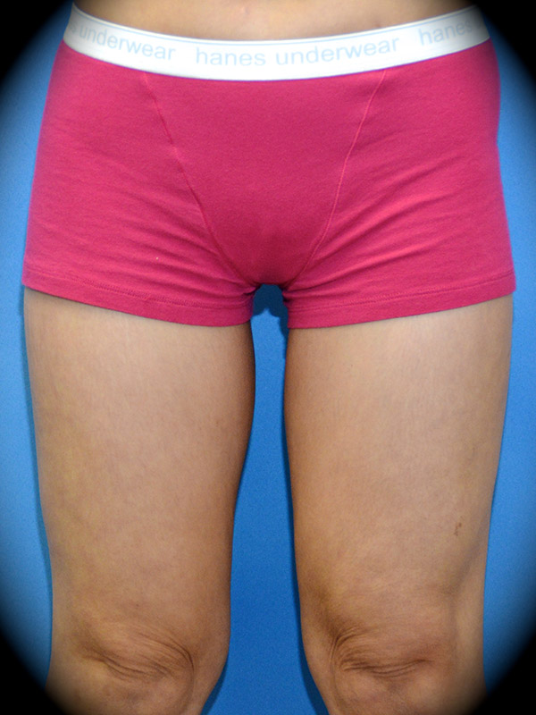 A result from Pasadena Cosmetic Surgery