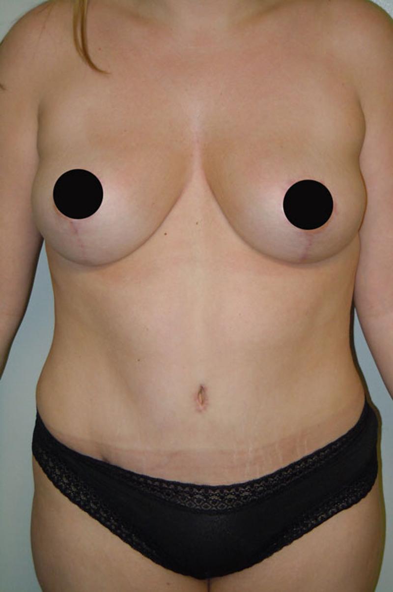 A result from Gartner Plastic Surgery