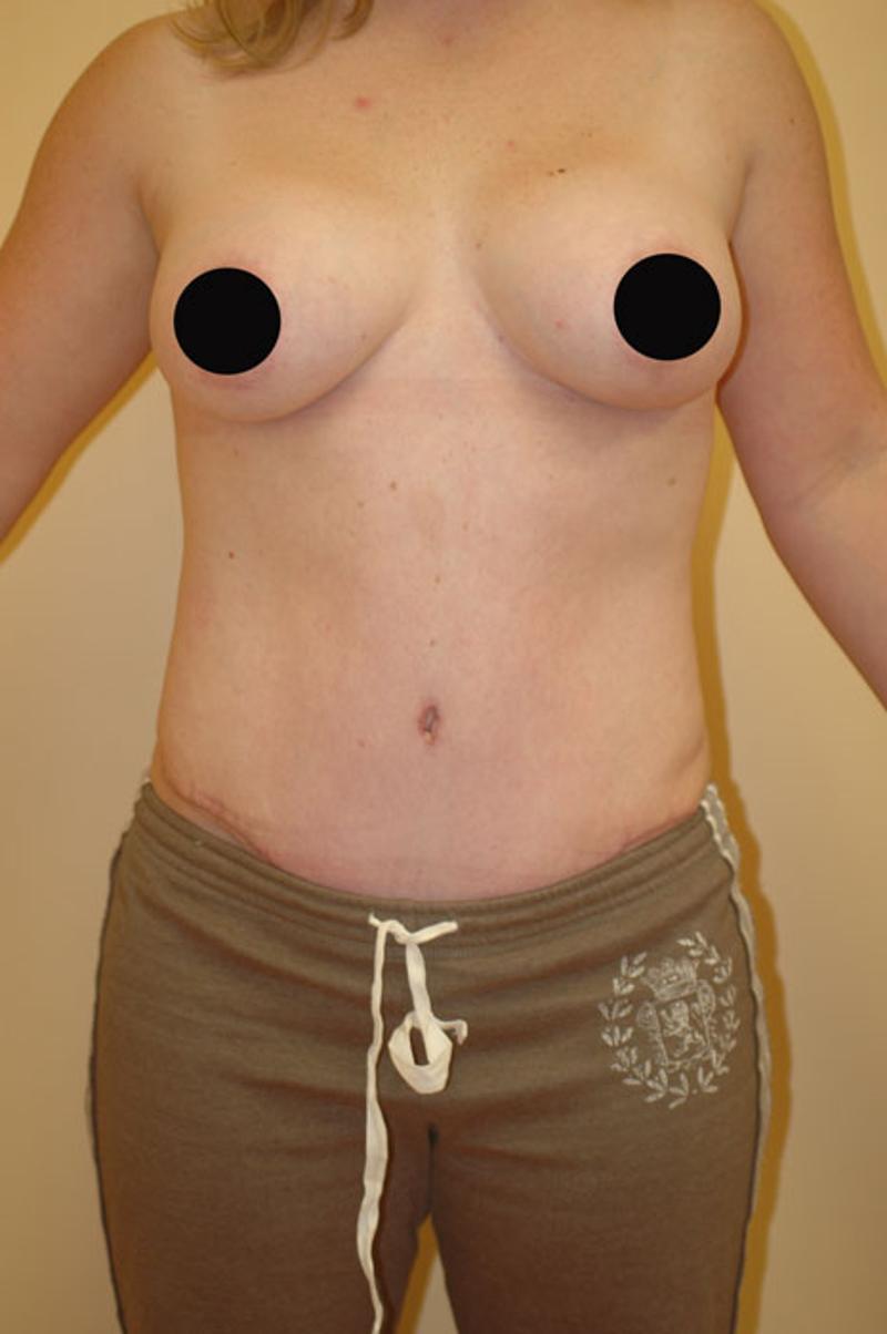 A result from Gartner Plastic Surgery