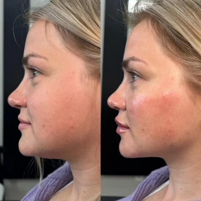 A result from Injections by Kylie