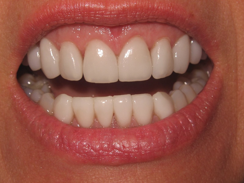 A result from Pomerado Cosmetic Dentistry