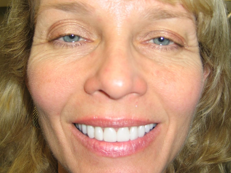 A result from Pomerado Cosmetic Dentistry