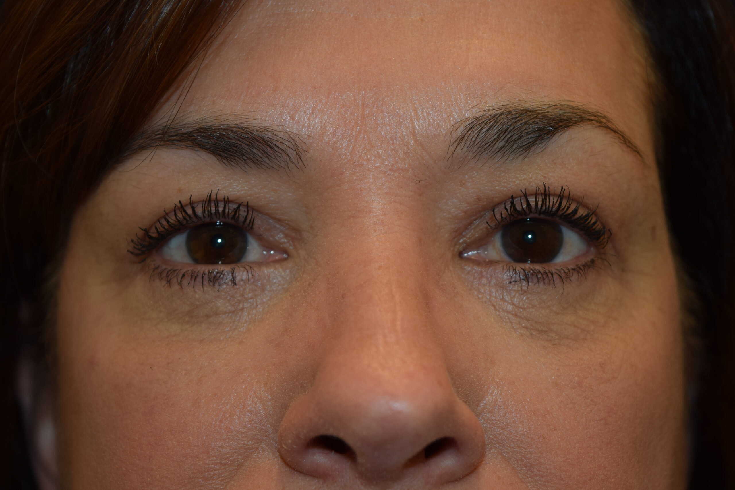 A result from Dr. Adam Basner Plastic Surgery