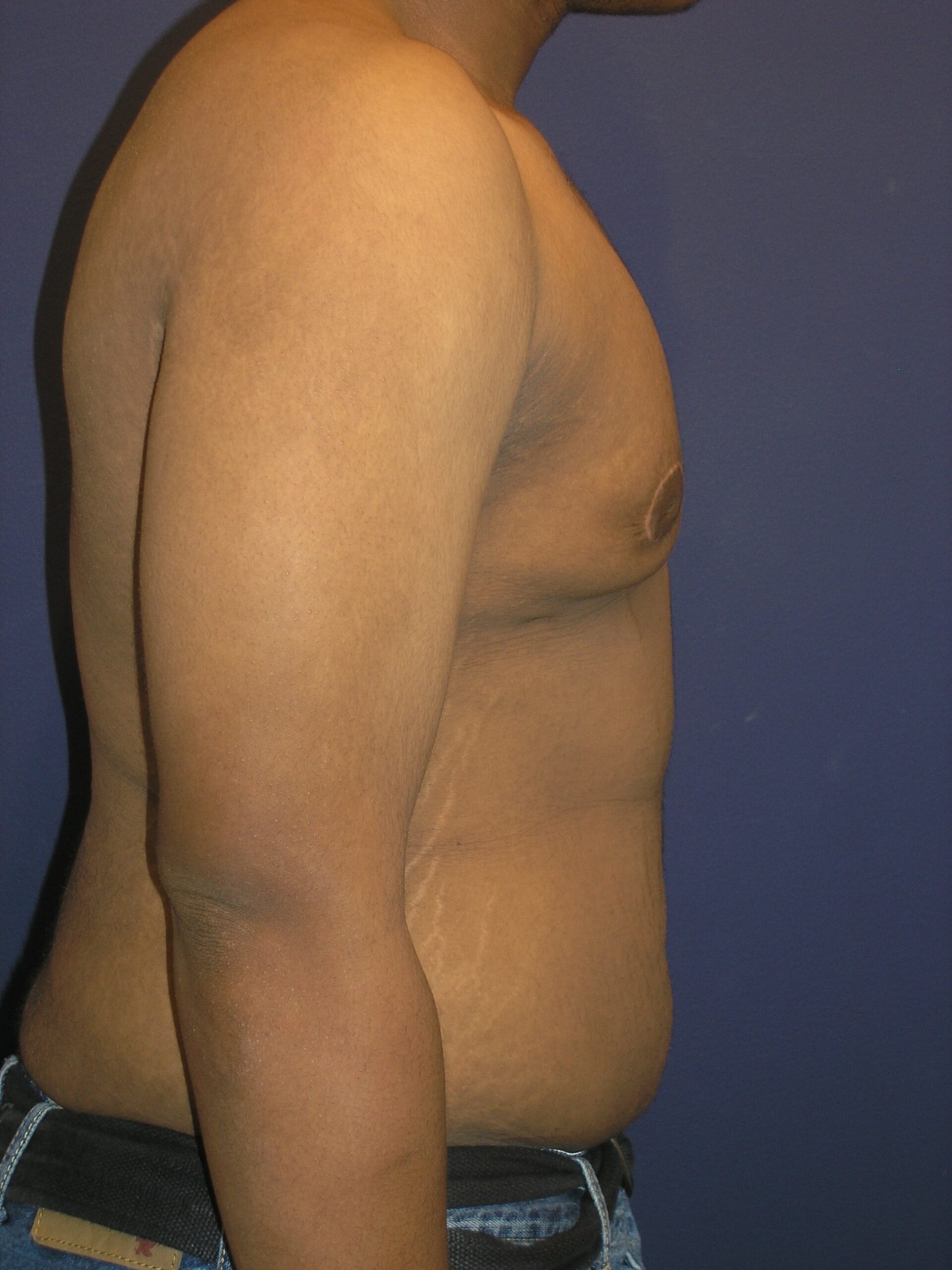 A result from Dr. Adam Basner Plastic Surgery