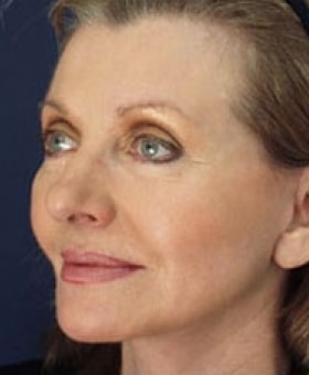 A result from Dr. Adam Basner Plastic Surgery