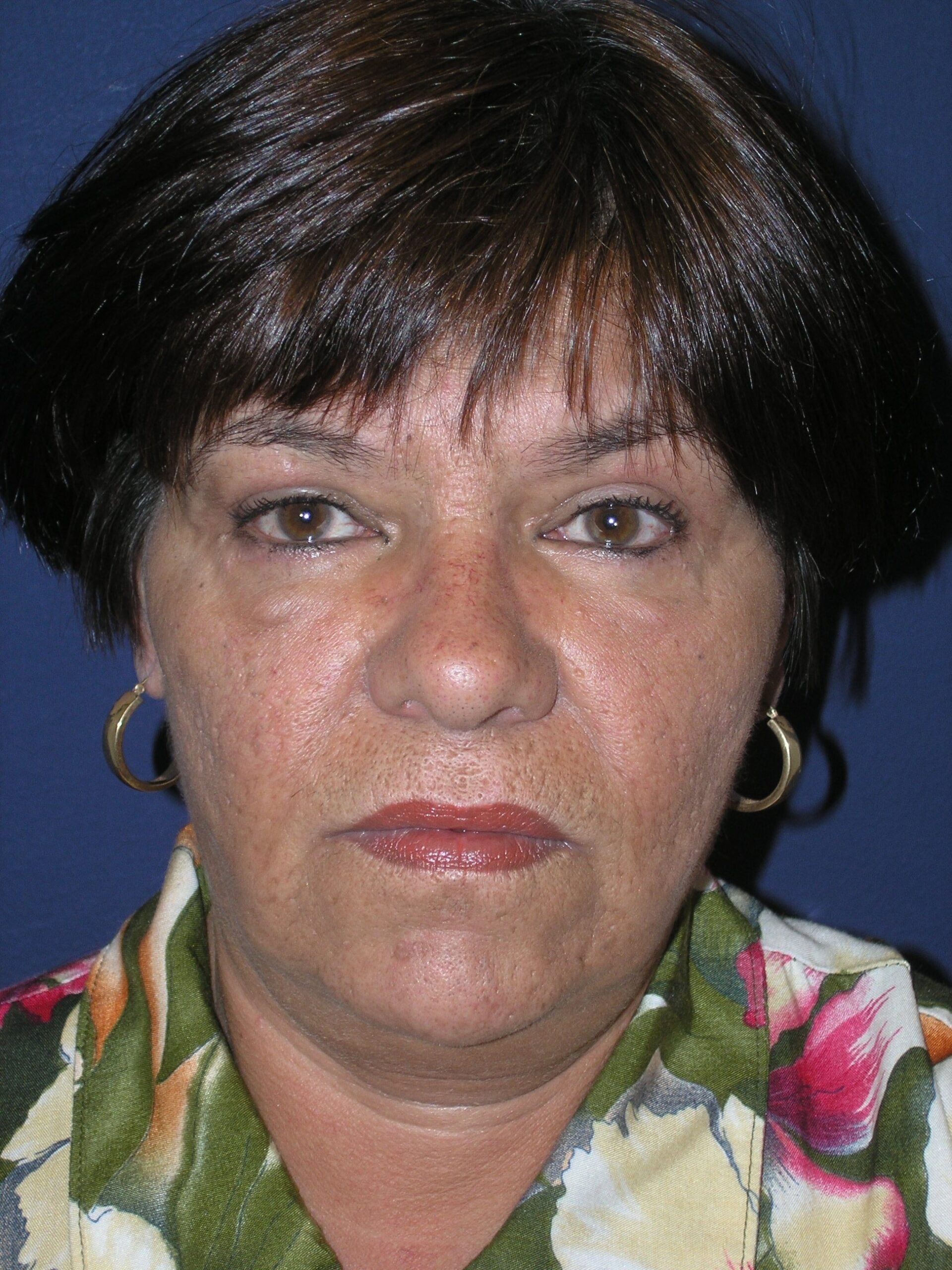 A result from Dr. Adam Basner Plastic Surgery
