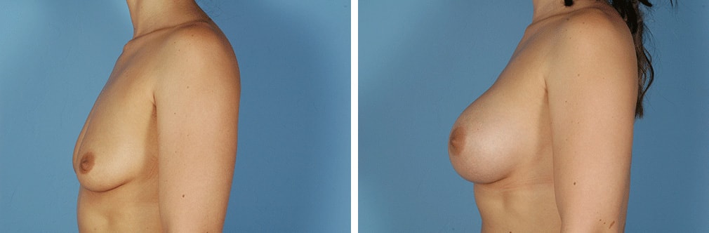 A result from Albuquerque Center for Plastic Surgery, William G. Loutfy MD