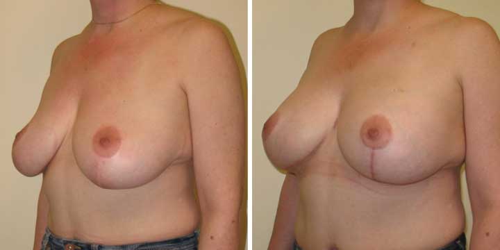 A result from Maier Plastic Surgery
