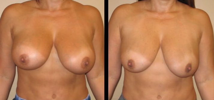 A result from Maier Plastic Surgery