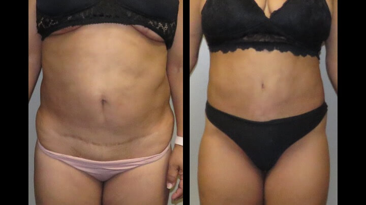 A result from Maier Plastic Surgery