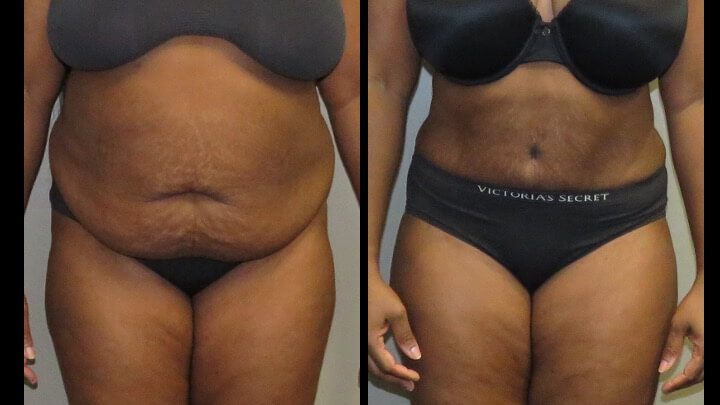 A result from Maier Plastic Surgery