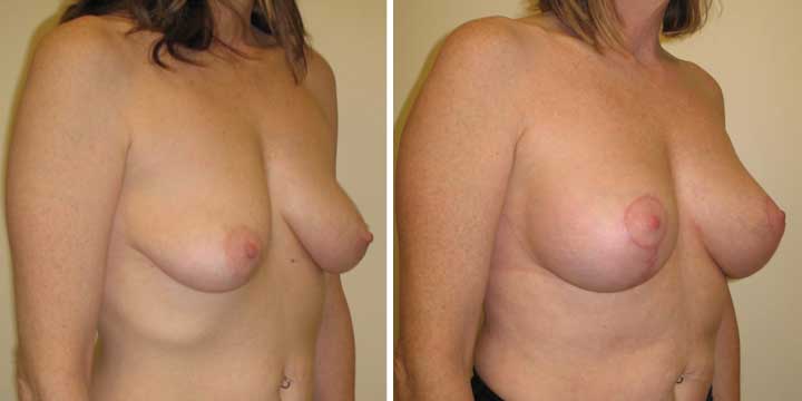 A result from Maier Plastic Surgery