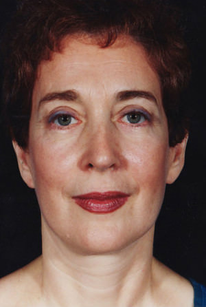 Facelift result at New York Plastic Surgery