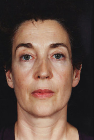 Facelift before photo