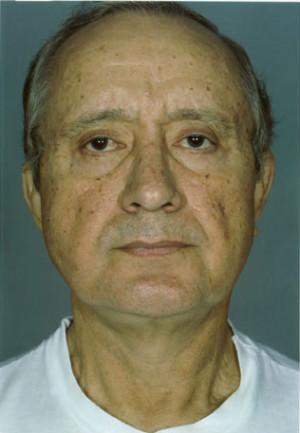 Facelift result at New York Plastic Surgery