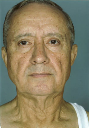 Facelift before photo