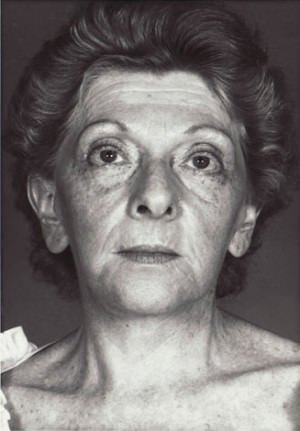 Facelift result at New York Plastic Surgery