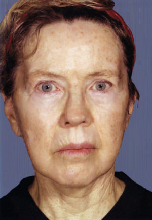 Facelift result at New York Plastic Surgery